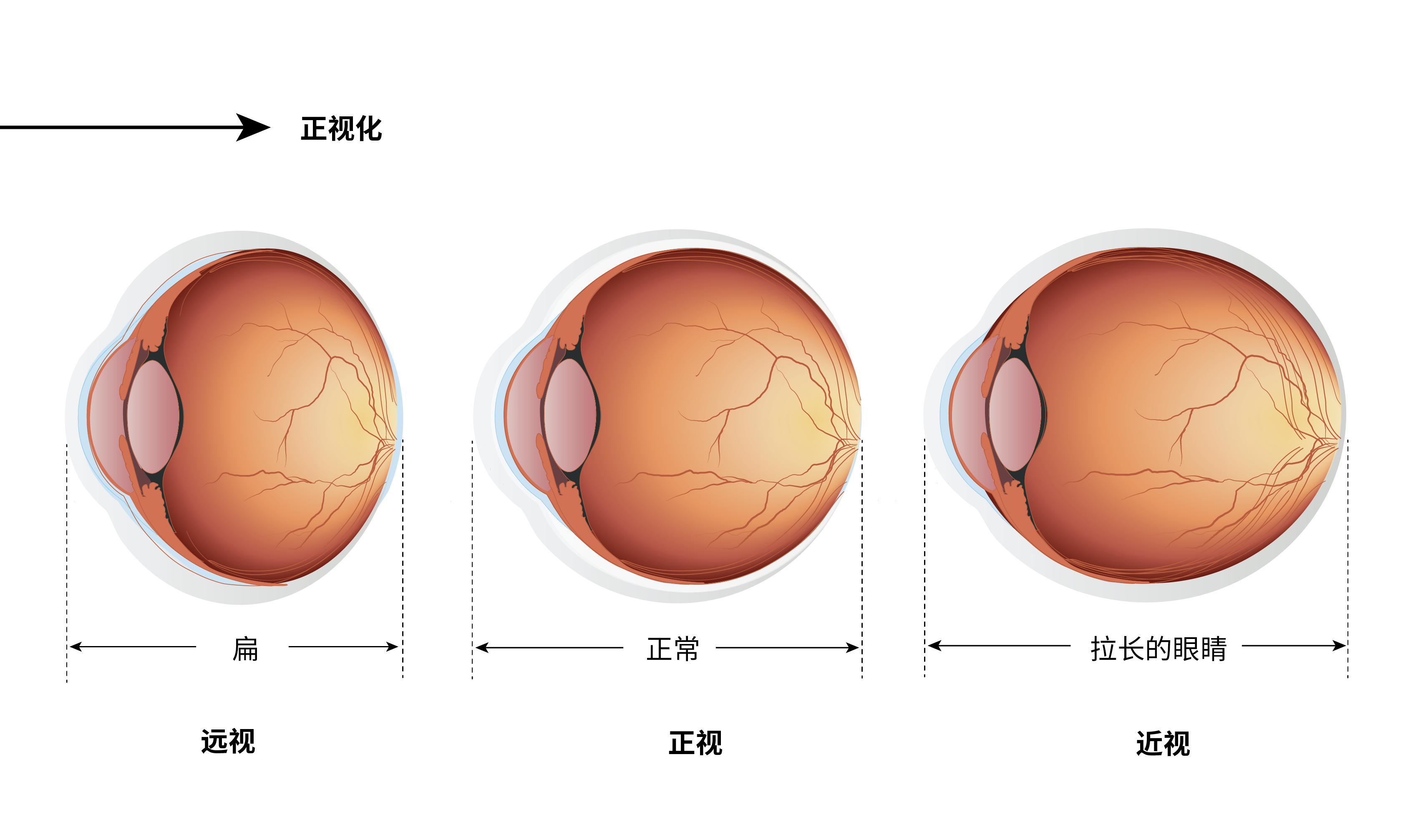 "远视储备"和近视究竟有何联系? - 知乎