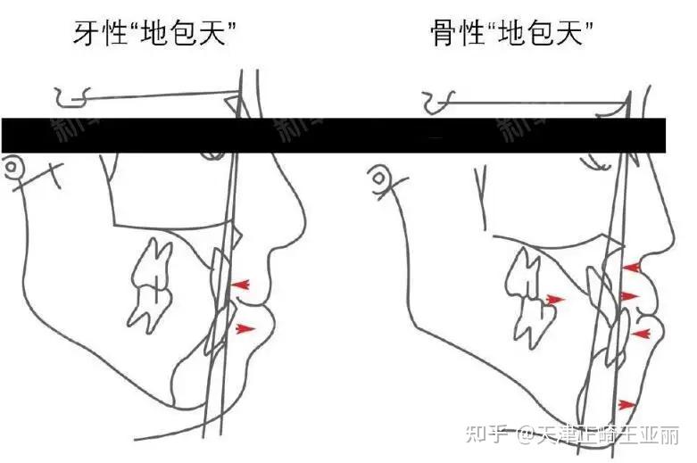 檢查後張口度正常,偶有關節彈響.關節無牙痛.