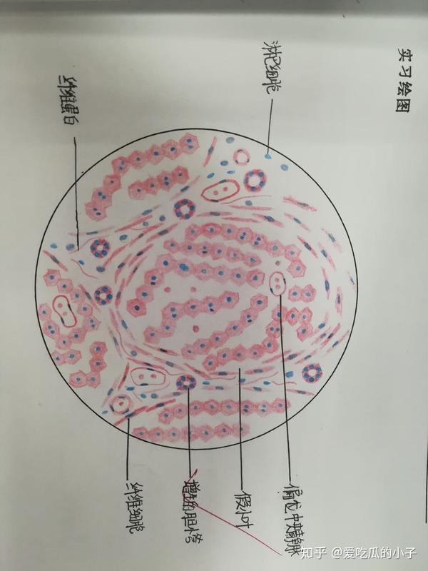 门脉性肝硬化 手绘图图片