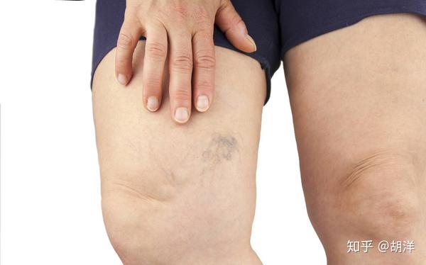 肺癌要预防一种厉害的致命杀手深静脉血栓可十分钟内致死