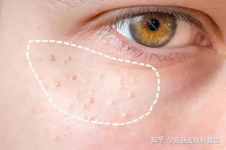 如何辨别 “脂肪粒、汗管瘤、扁平疣”？ - 知乎