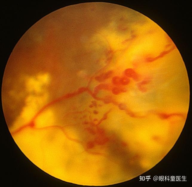 外层渗出性视网膜病变(coats病)