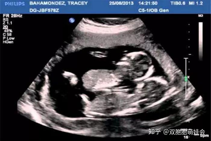 b超孕15周的双胞胎胎儿影像图7070:孕15周的双胞胎胎儿发育图70