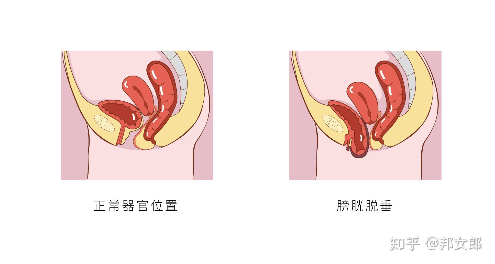 膀胱脱垂图片真实图片图片