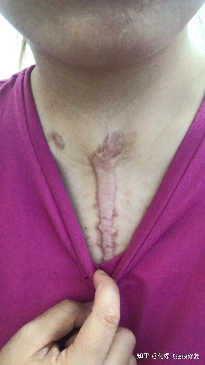 缩胸手术的疤痕图片图片