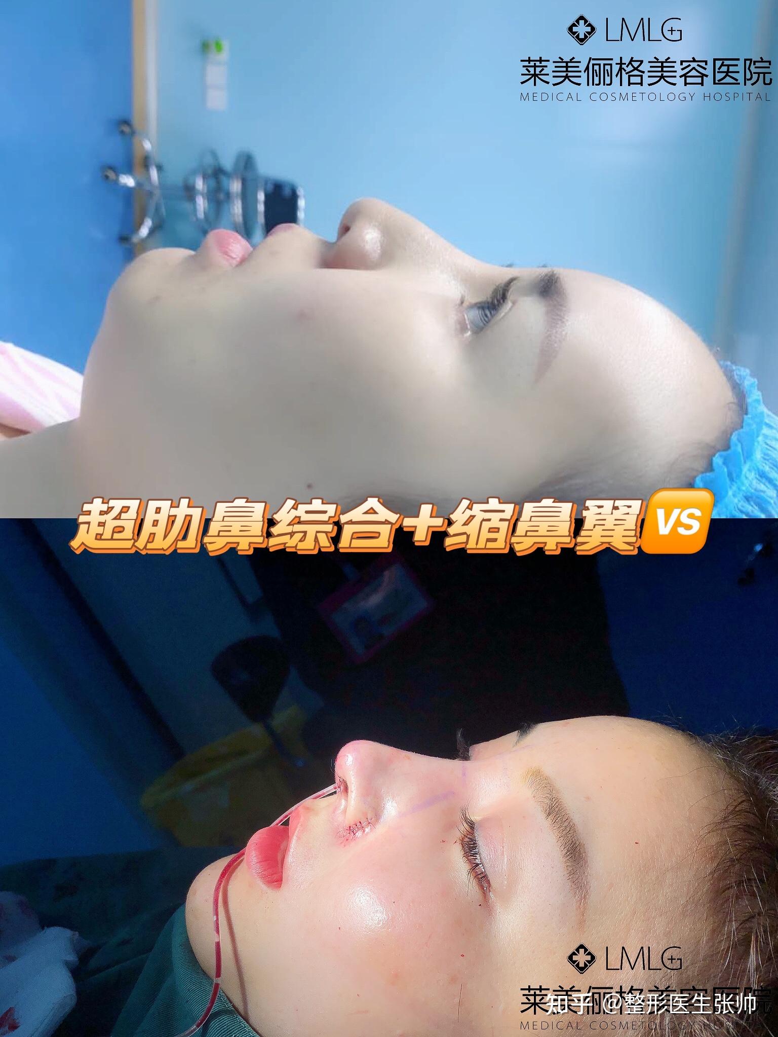 哪些鼻子适合做鼻翼缩小手术