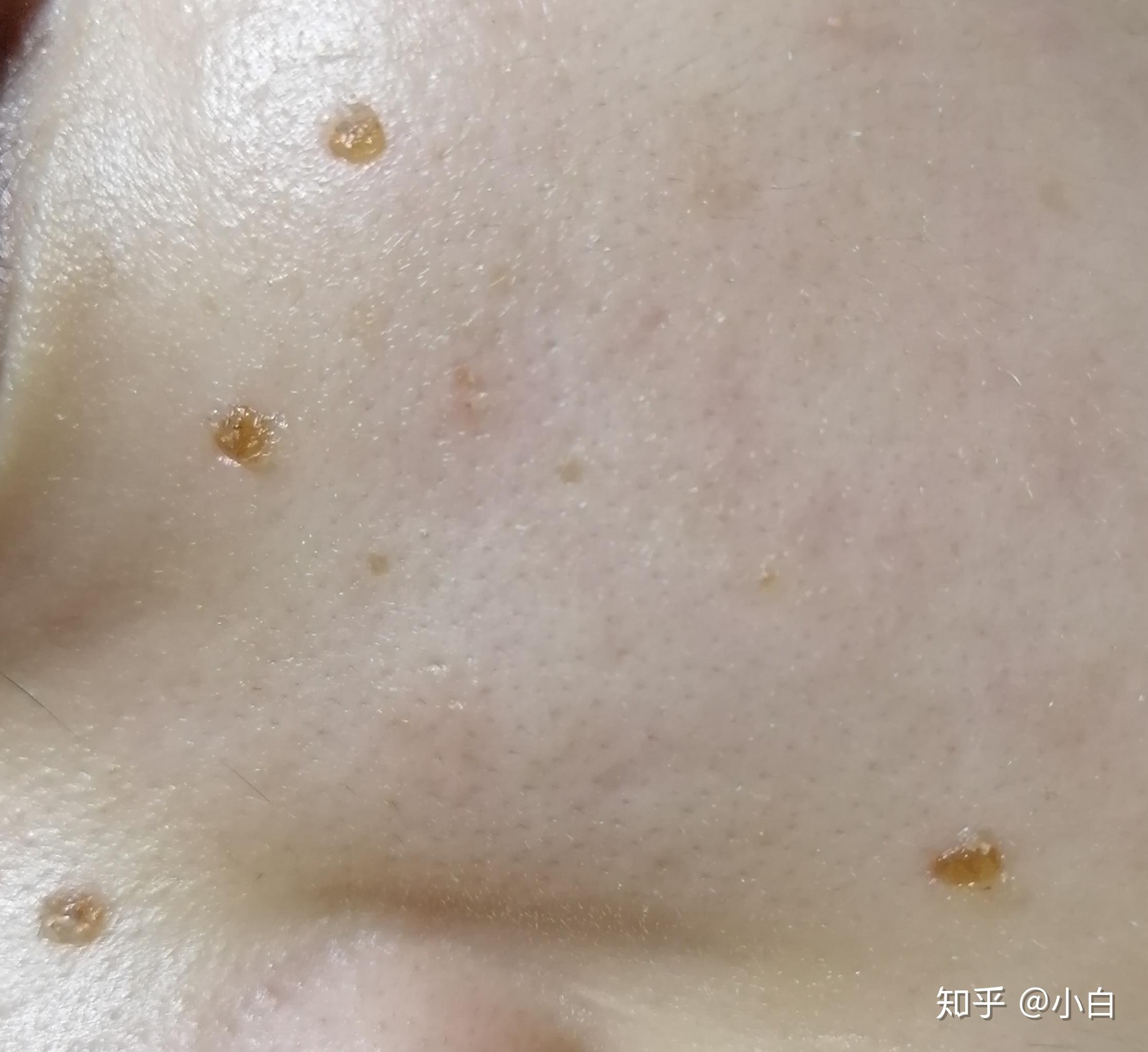 激光去痣,更新,复发了两颗