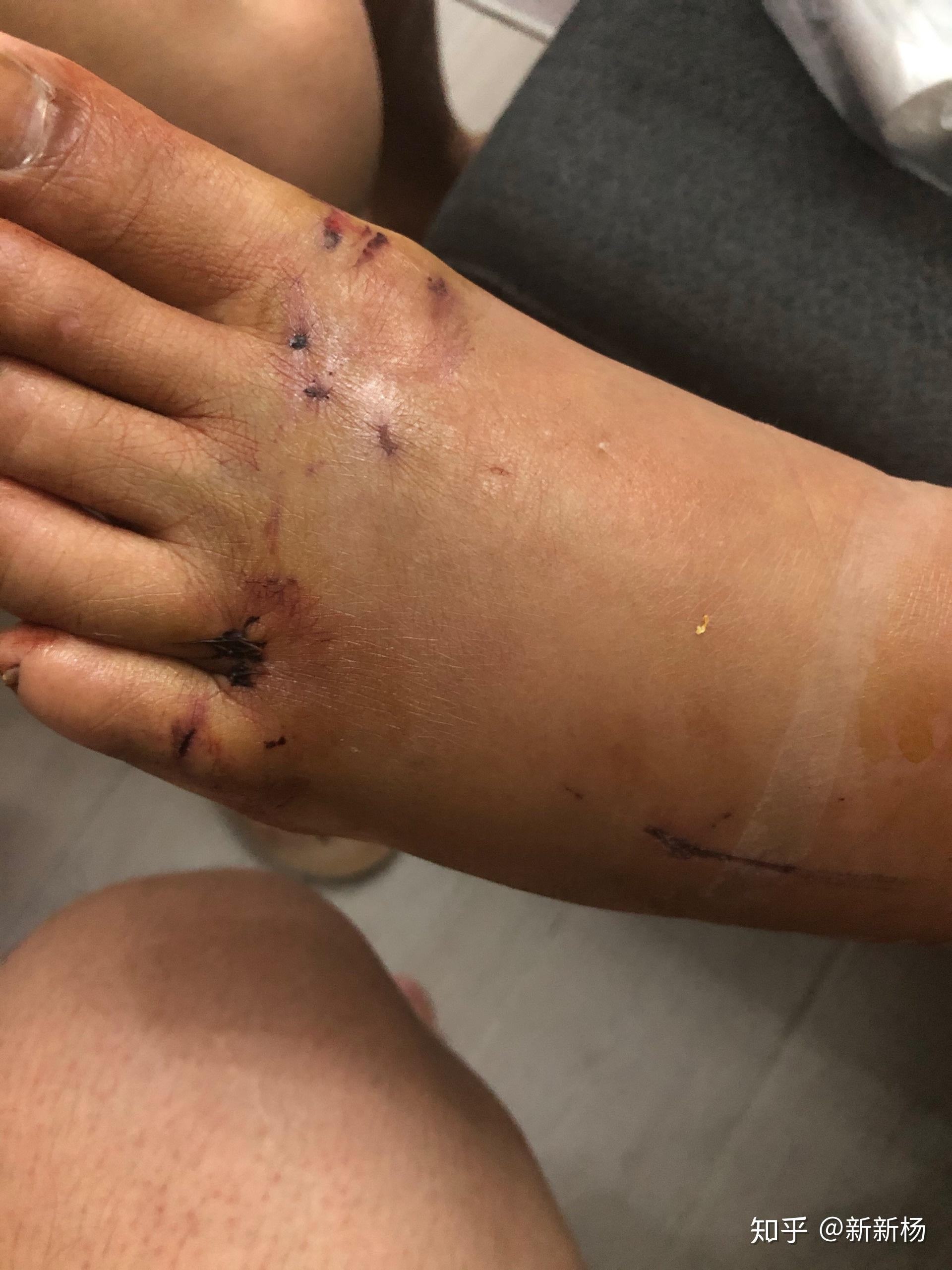 记录脚部外伤瘀血