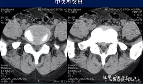 腰椎骨质增生ct图片