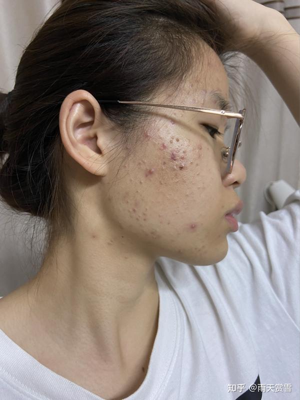 果酸祛痘效果好不好,怎么祛痘比较好?