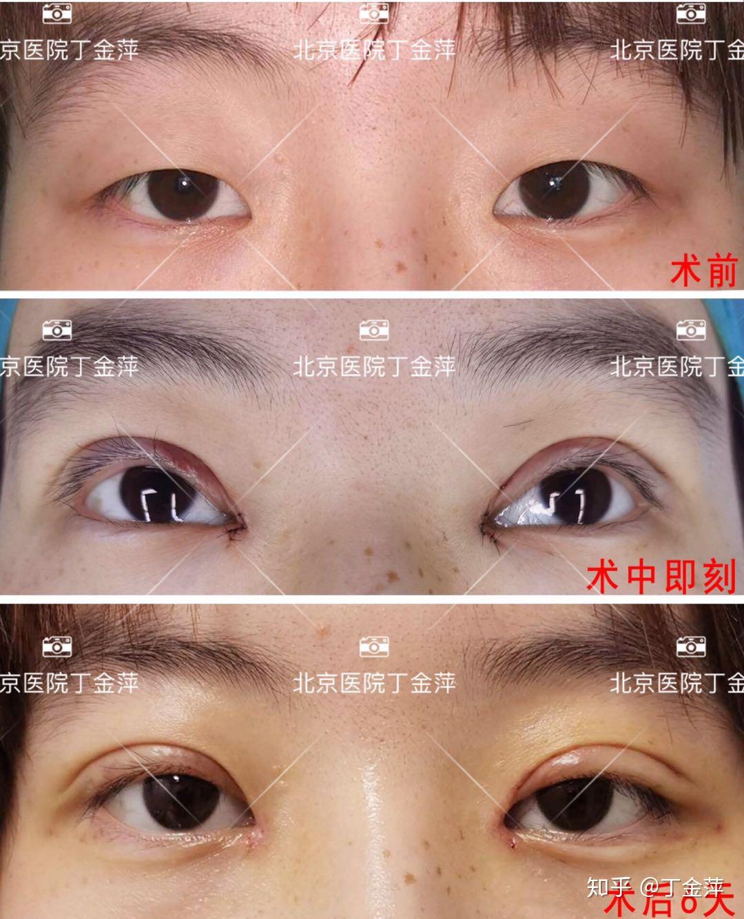 全切双眼皮（眼综合）上眼睑提肌恢复过程 - 知乎