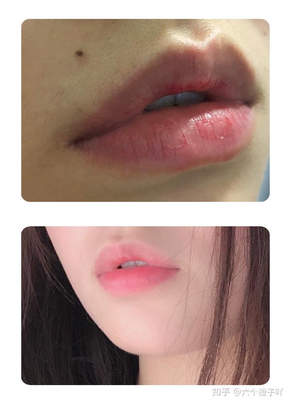嘴唇干裂起皮 唇色深 怎么治愈看这里 知乎