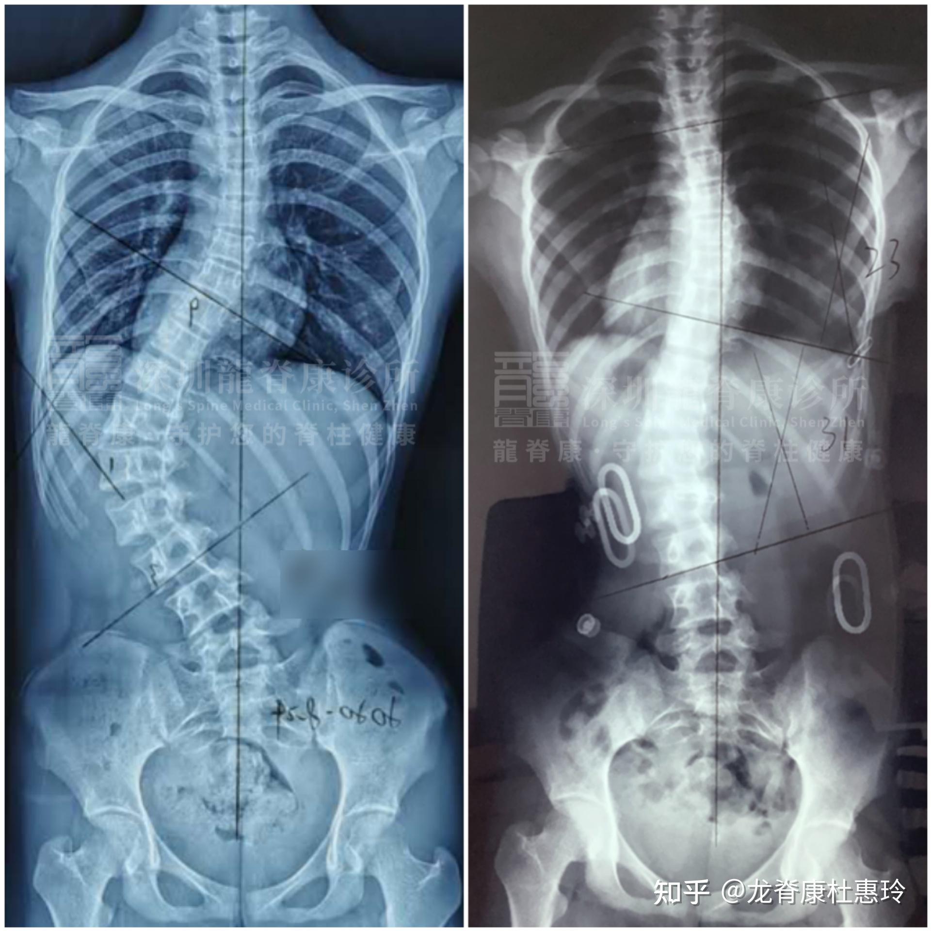 脊椎侧弯x光片图片