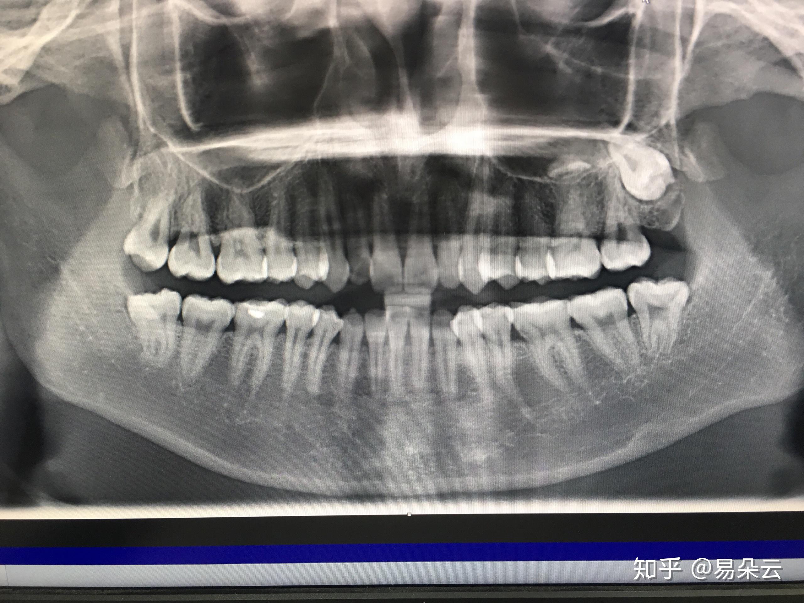 上頜骨有顆智齒長得太有個性了?撥這顆智齒麻煩不?