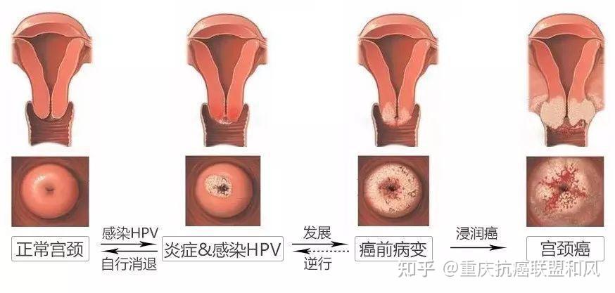 宫颈癌长虫子图片图片