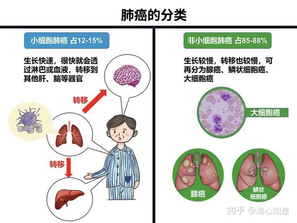 肺癌的一生 当我们与肺癌不期而遇 知乎