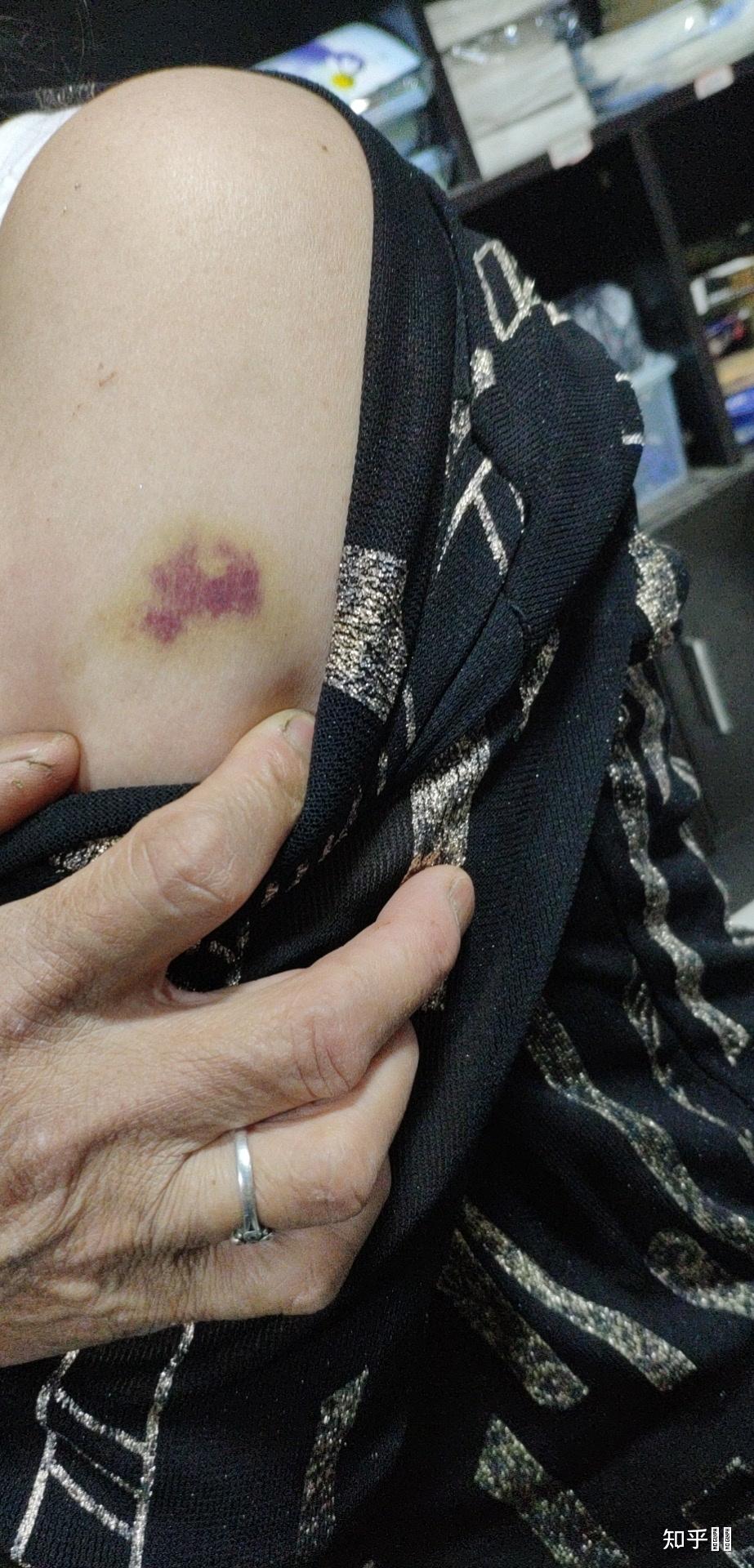 新冠疫苗接种后为何针眼地方是黑的