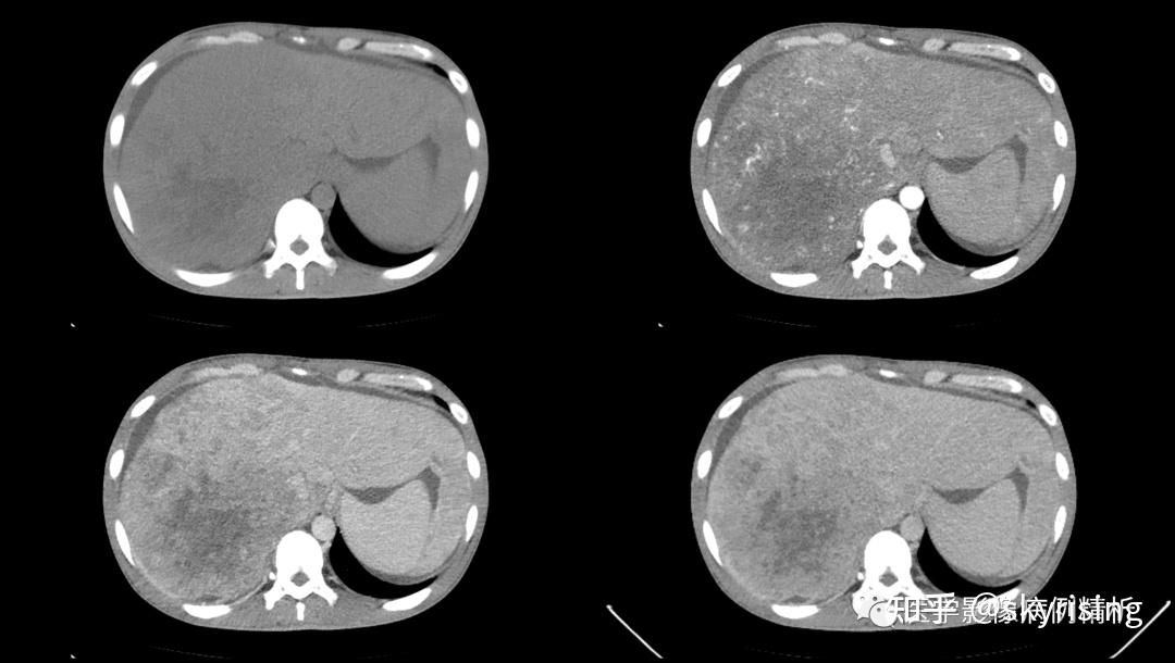 肝肿瘤ct显示图片图片