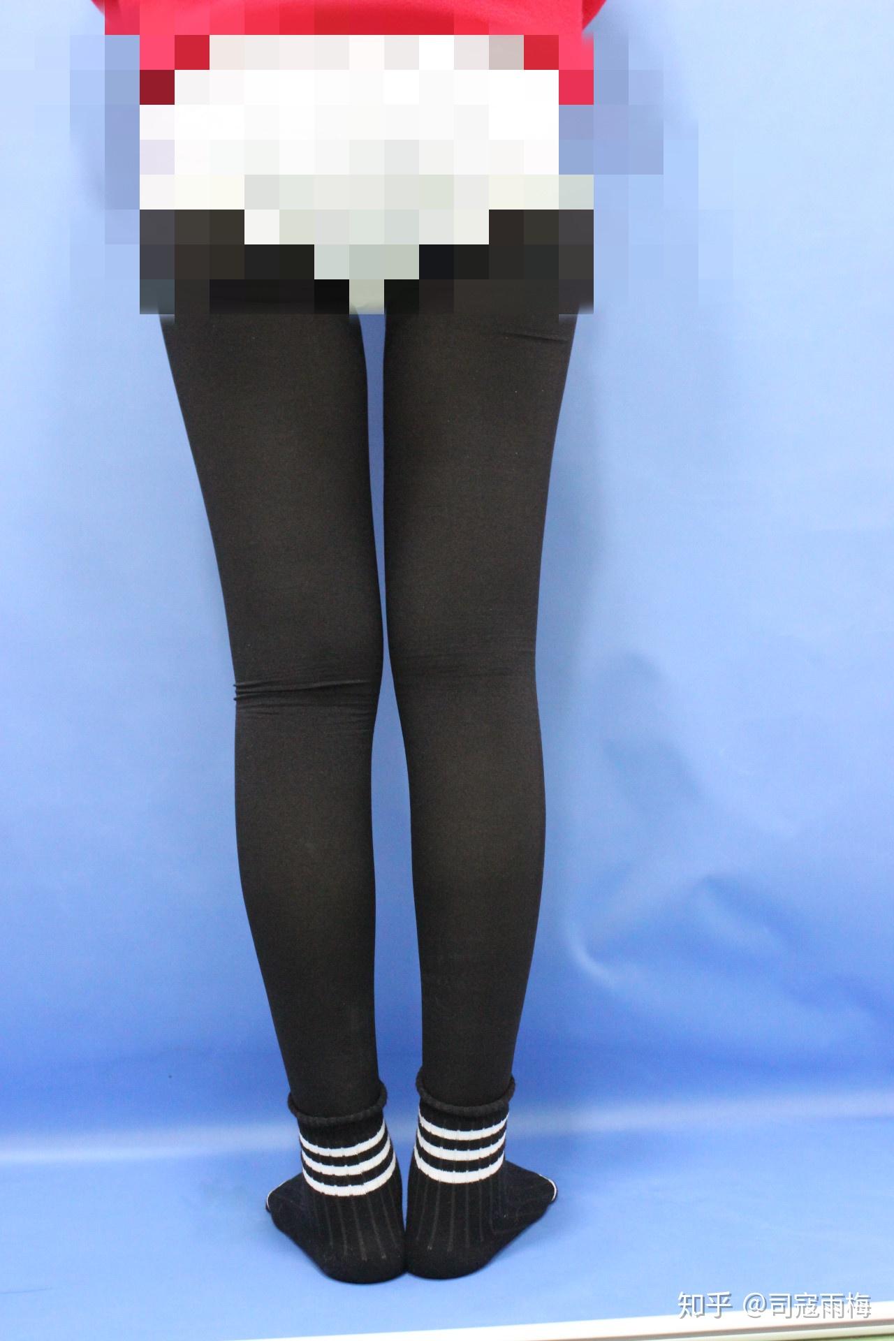 大腿环吸5个月案例