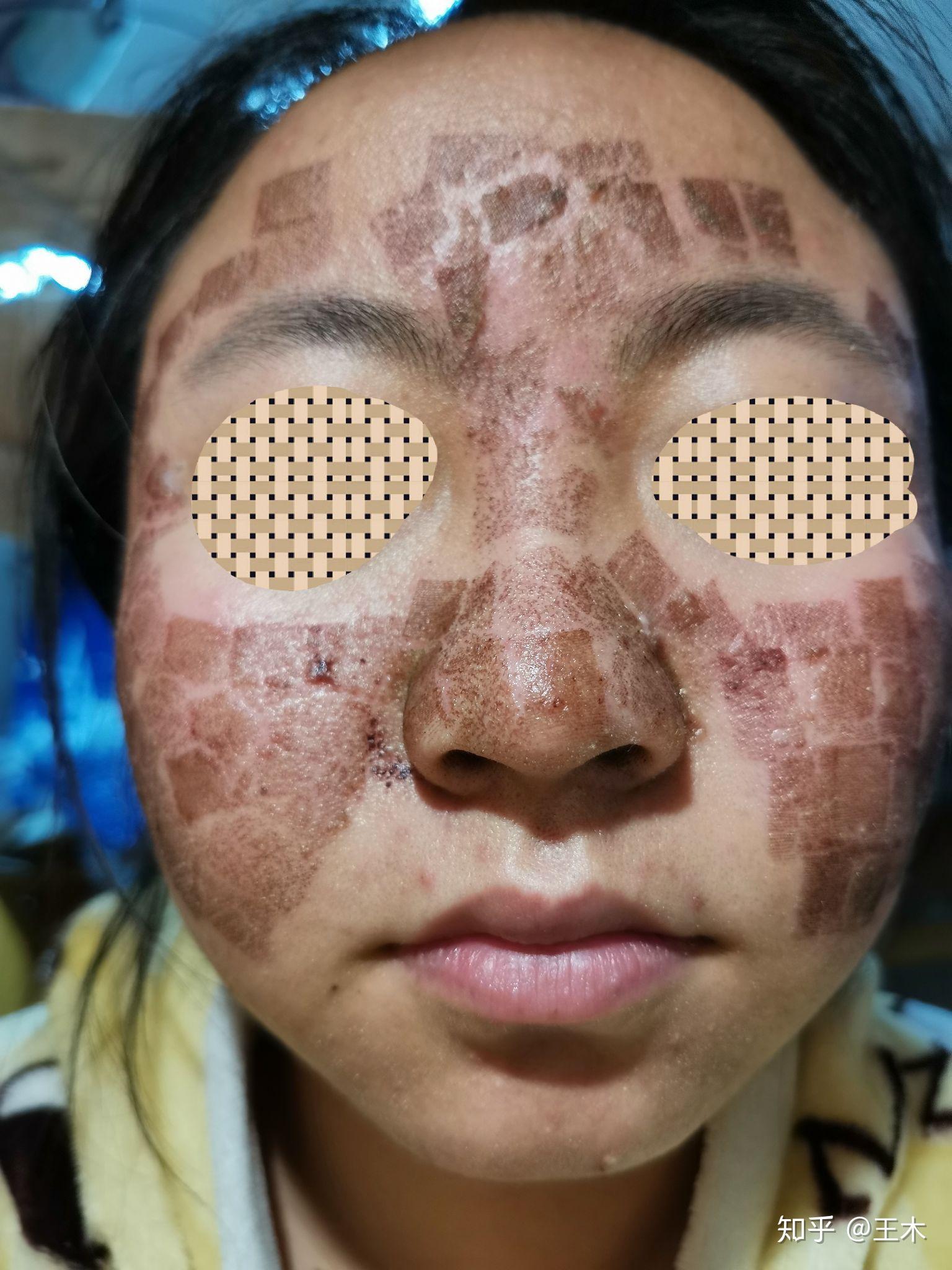 二氧化碳点阵激光祛除痘坑经验分享