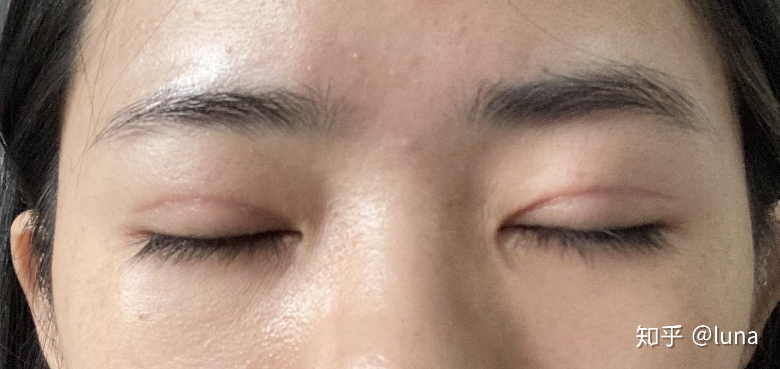 双眼皮全切记录