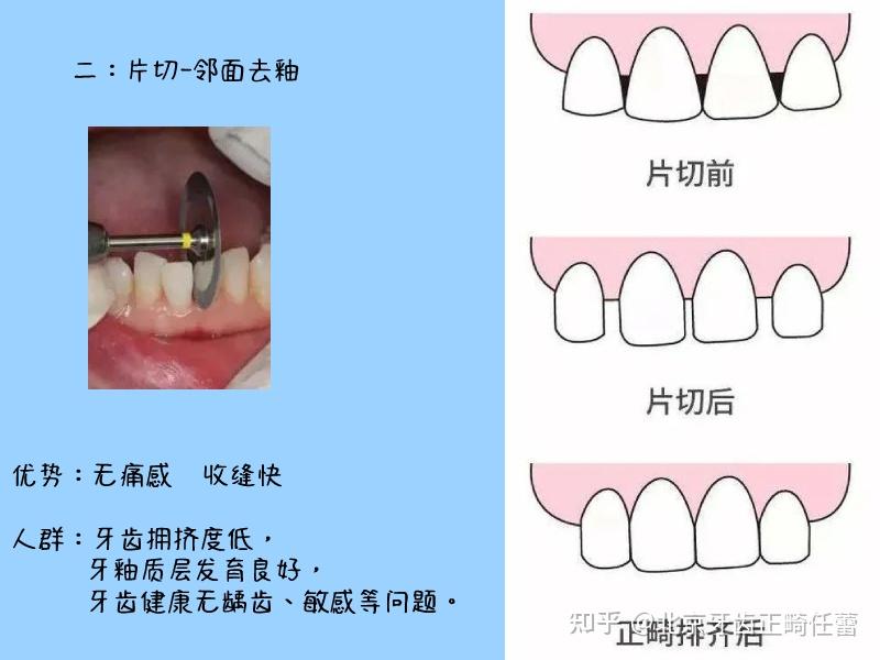 牙齒擁擠一定要拔牙矯正嗎? - 知乎