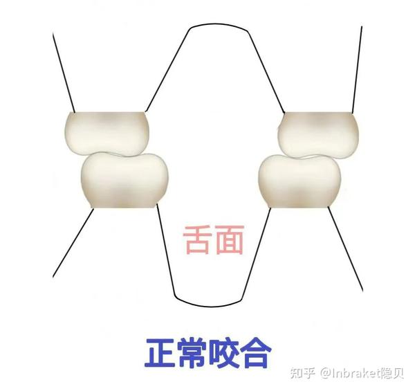 什么是正畸颌垫?为什么矫牙需要粘颌垫? - 知乎