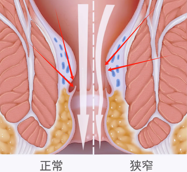 痔疮在什么位置图片图片