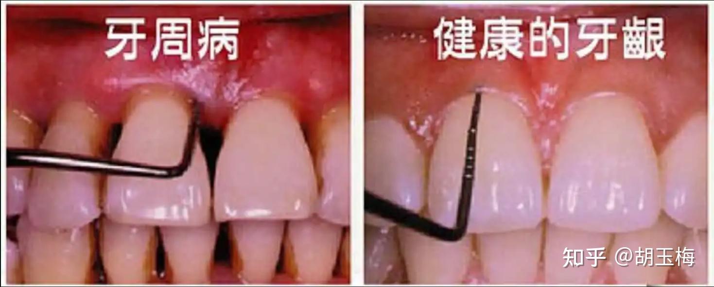 科普丨牙周炎和牙龈炎有什么区别