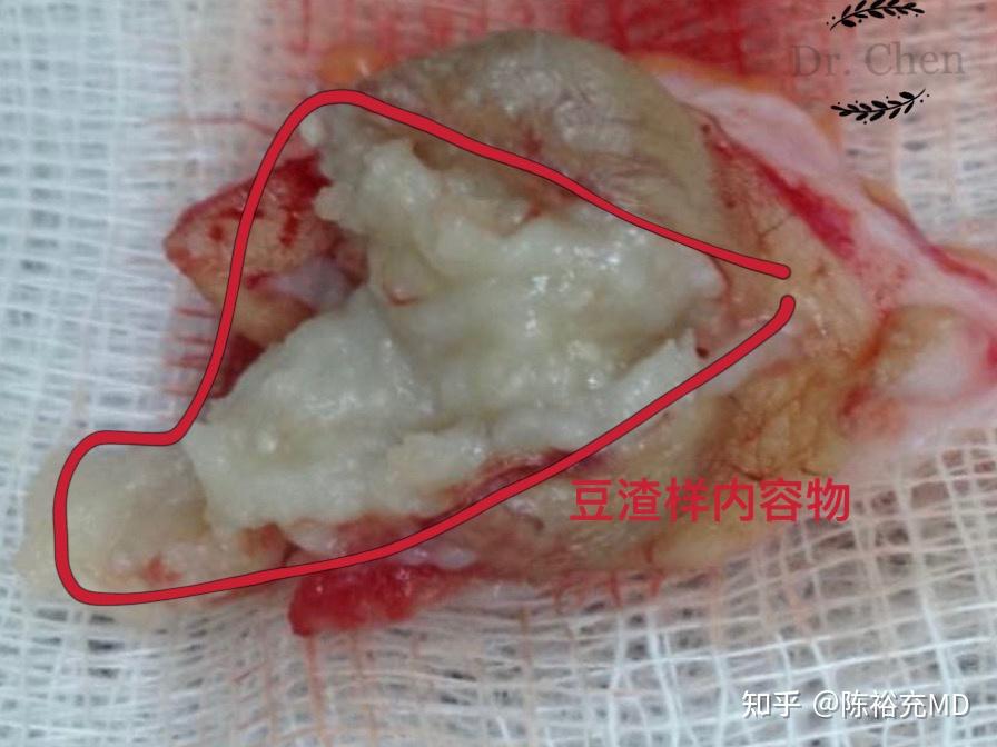 表皮样囊肿长得什么样该怎么治疗