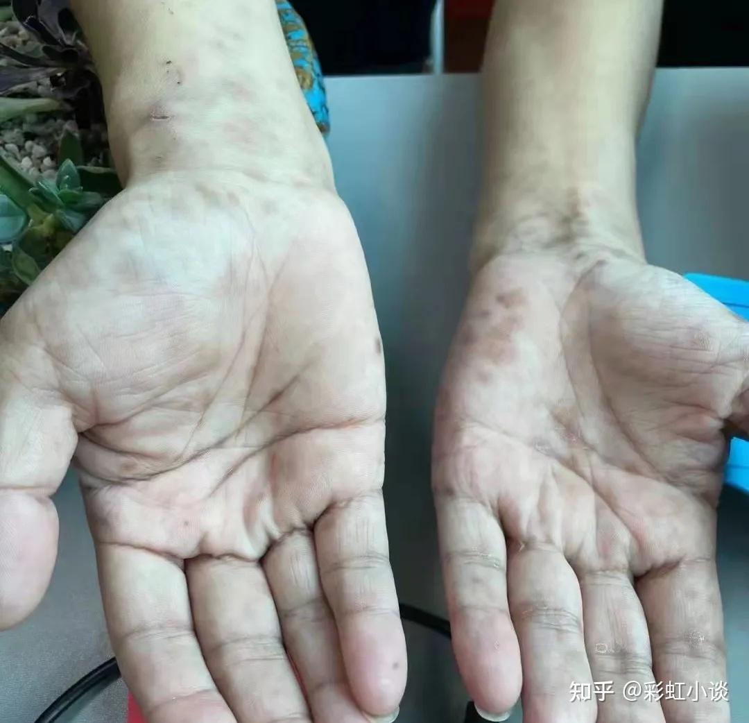 梅毒皮疹二期梅毒病毒可以通过血液循环达到扩散,引发全身性的症状.