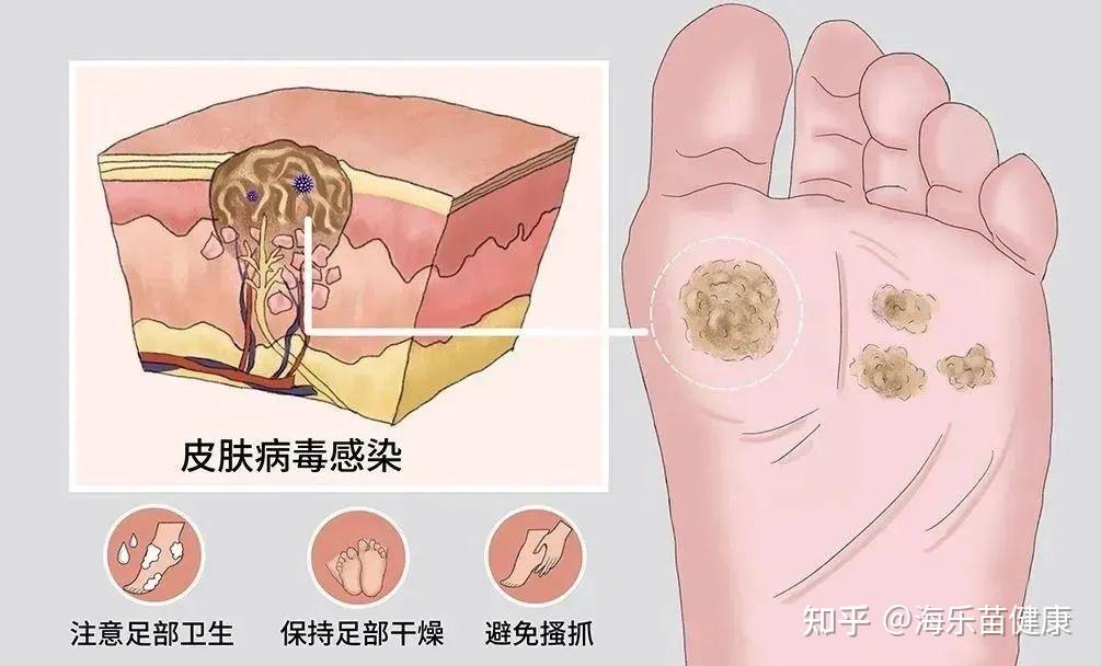 無論男女,身上長這5種肉疙瘩,可能是感染了hpv! - 知乎