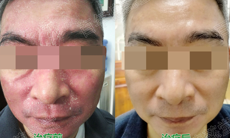各类常见皮炎的症状有哪些