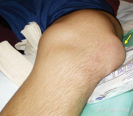 大三女生,右髌骨脱位了,怎么办?