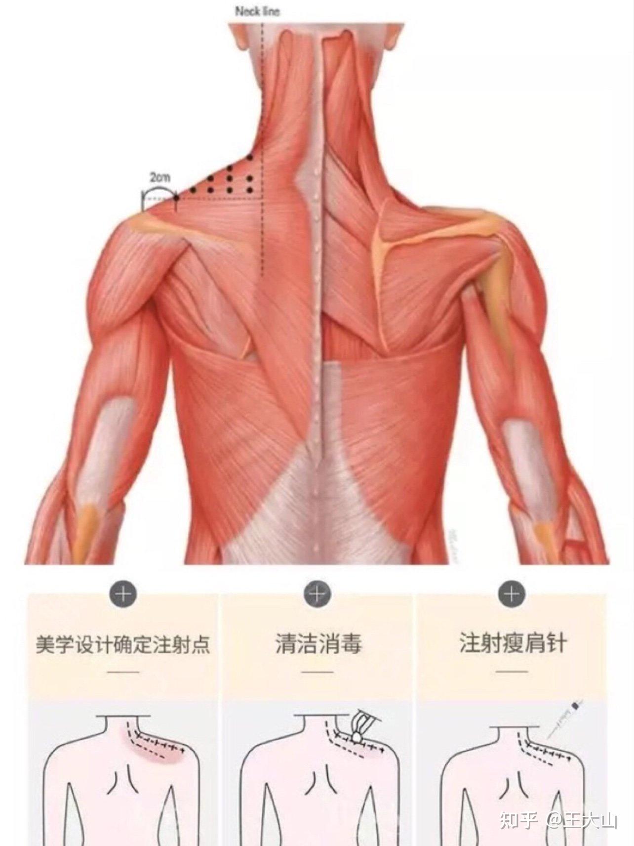 肉毒瘦肩肌几点定位图图片