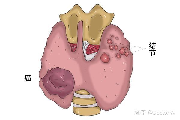 查出甲狀腺結節會惡化成癌嗎避開三種食物結節或會慢慢消散