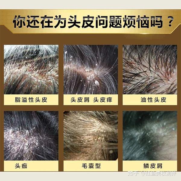头皮毛囊炎用什么洗发水? - 知乎