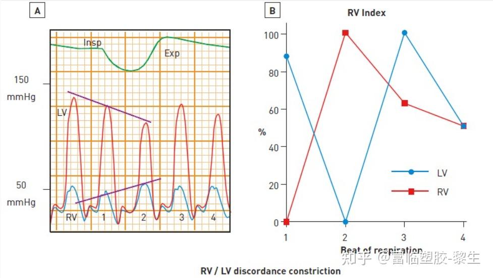 右心和左心:血流动力学的基础知识 - 知乎