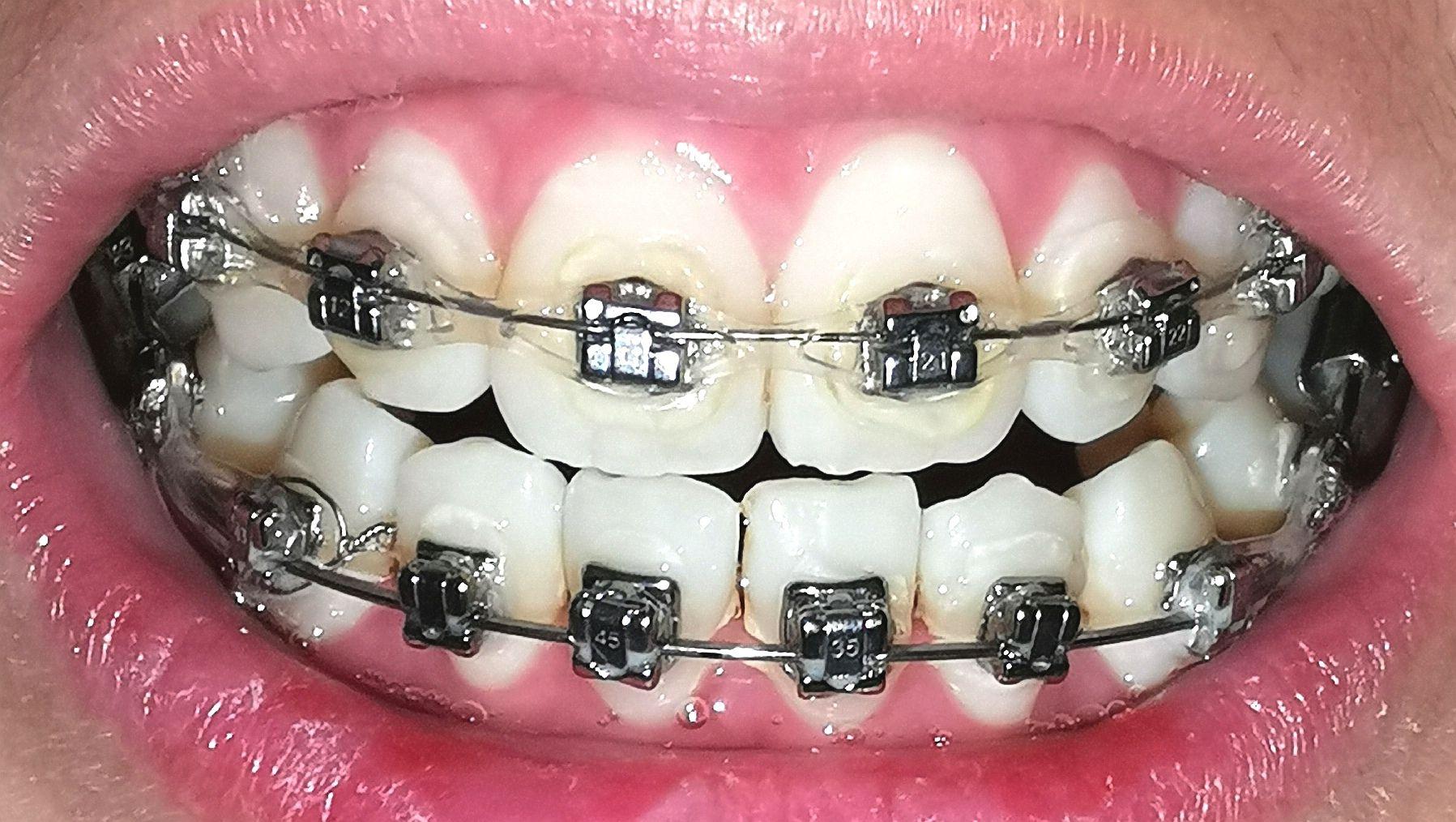 上牙戴了橡皮链了这是没戴牙套的样子戴了半年的样子,我中线不齐,等