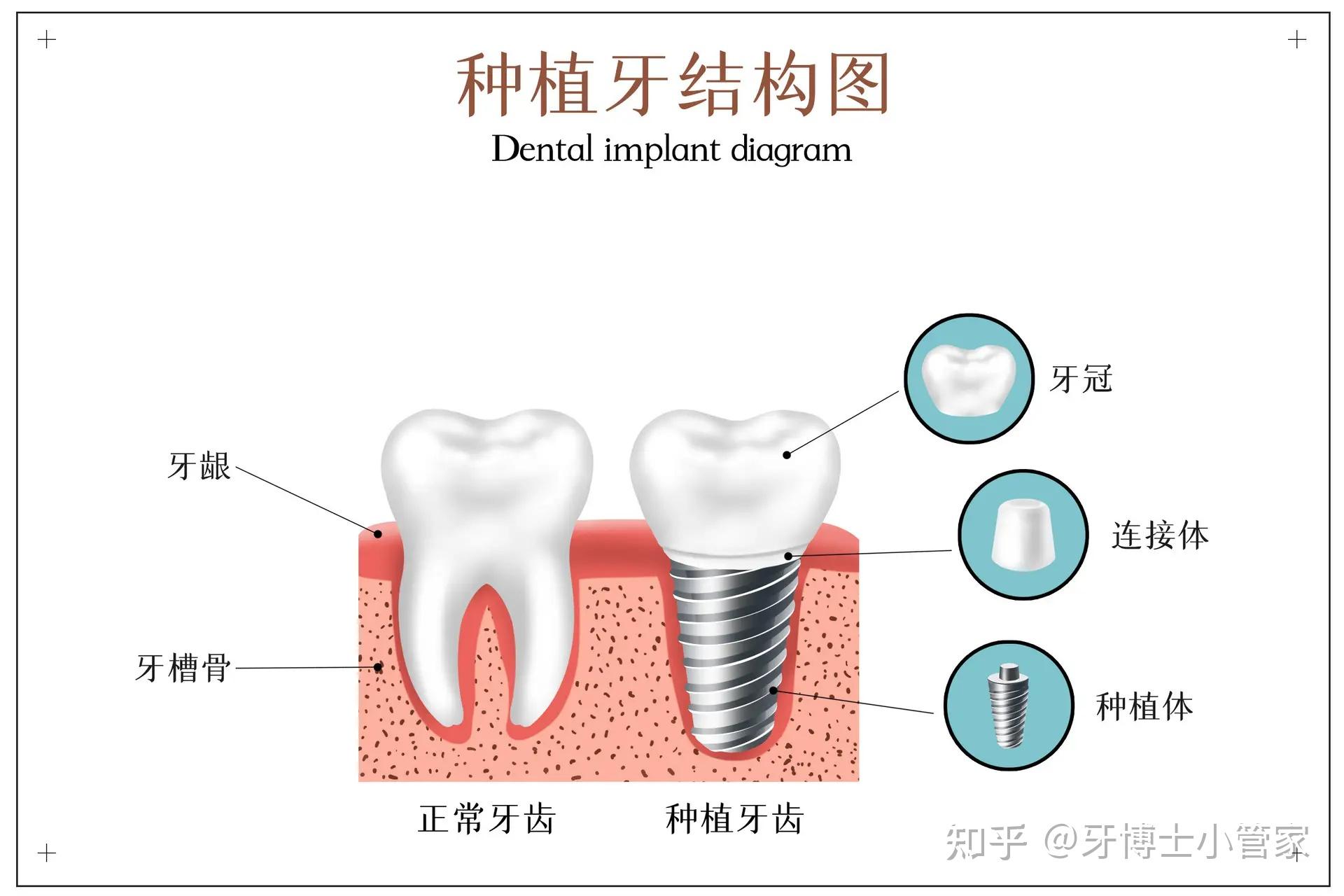 杭州种植牙多少钱一颗?