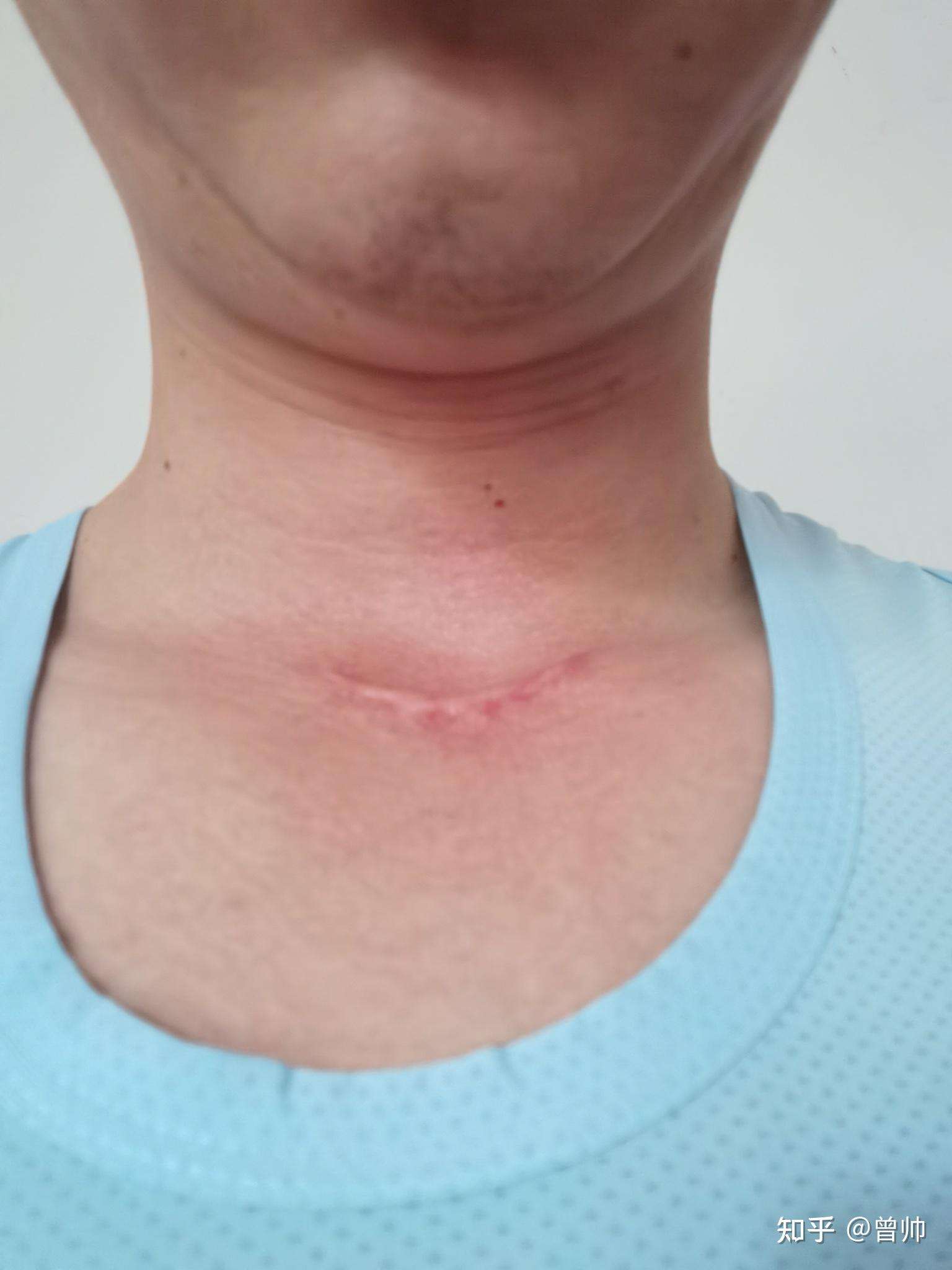 甲状腺乳头状癌手术后10个月 - 知乎