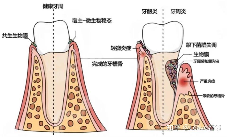 当牙周病发生时