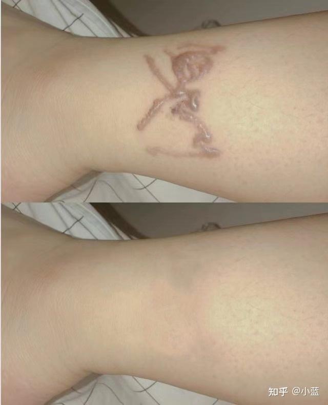 纹身洗掉后的疤痕图片图片