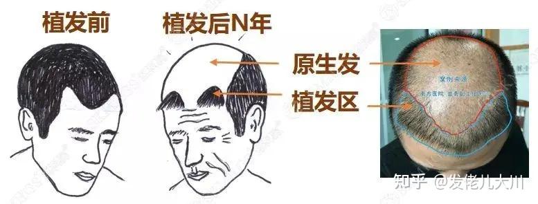 为什么专家不建议植发？网上6880包干价是真的吗？回答一波植发热门问题 - 知乎