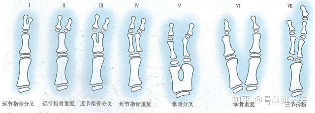 “六指神童”的六指是怎么来的? - 知乎