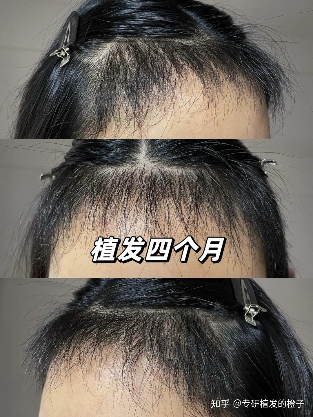 yz植发机构(植发机构知乎)