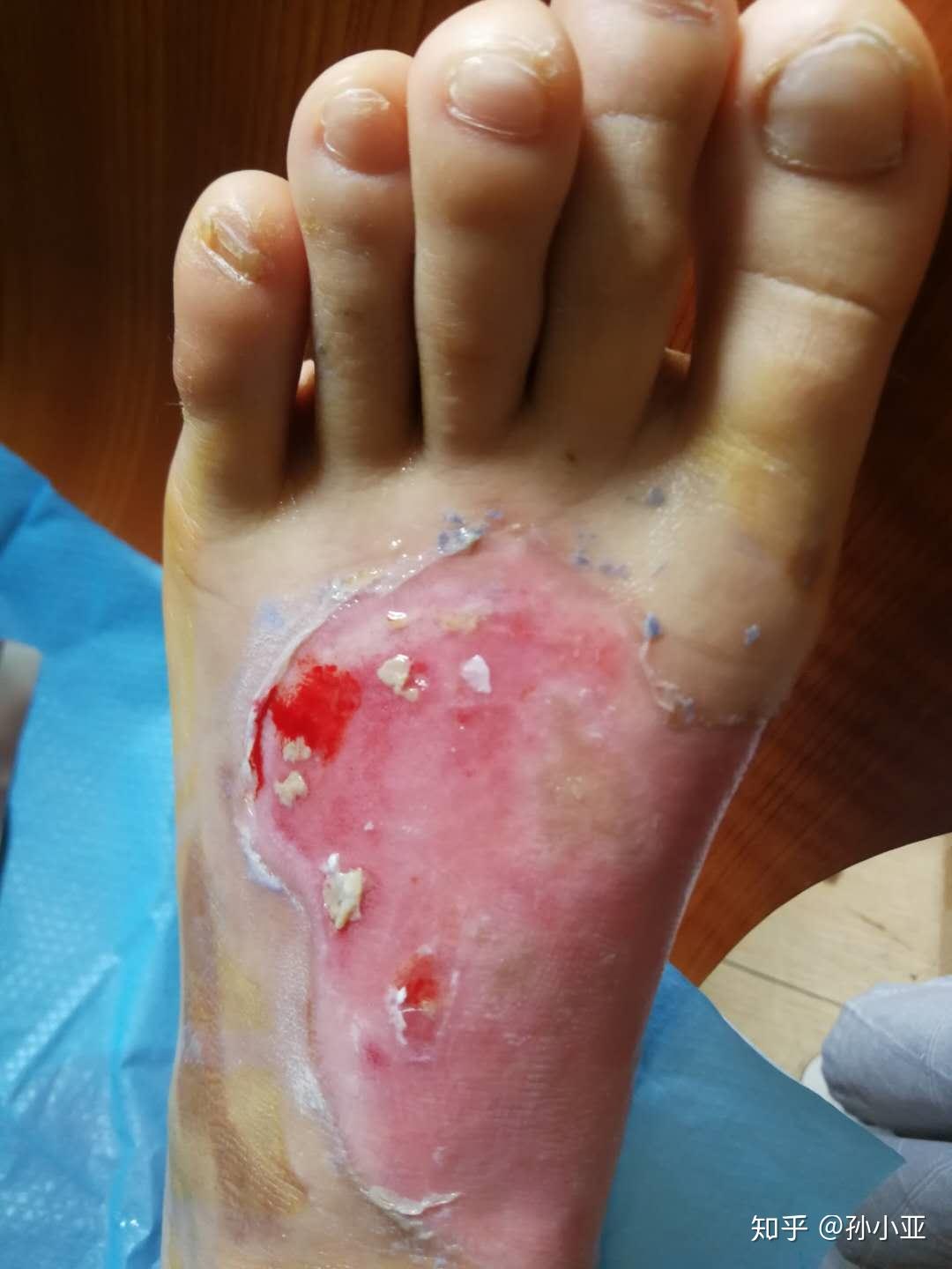 被开水烫伤之后该怎么办 - 知乎