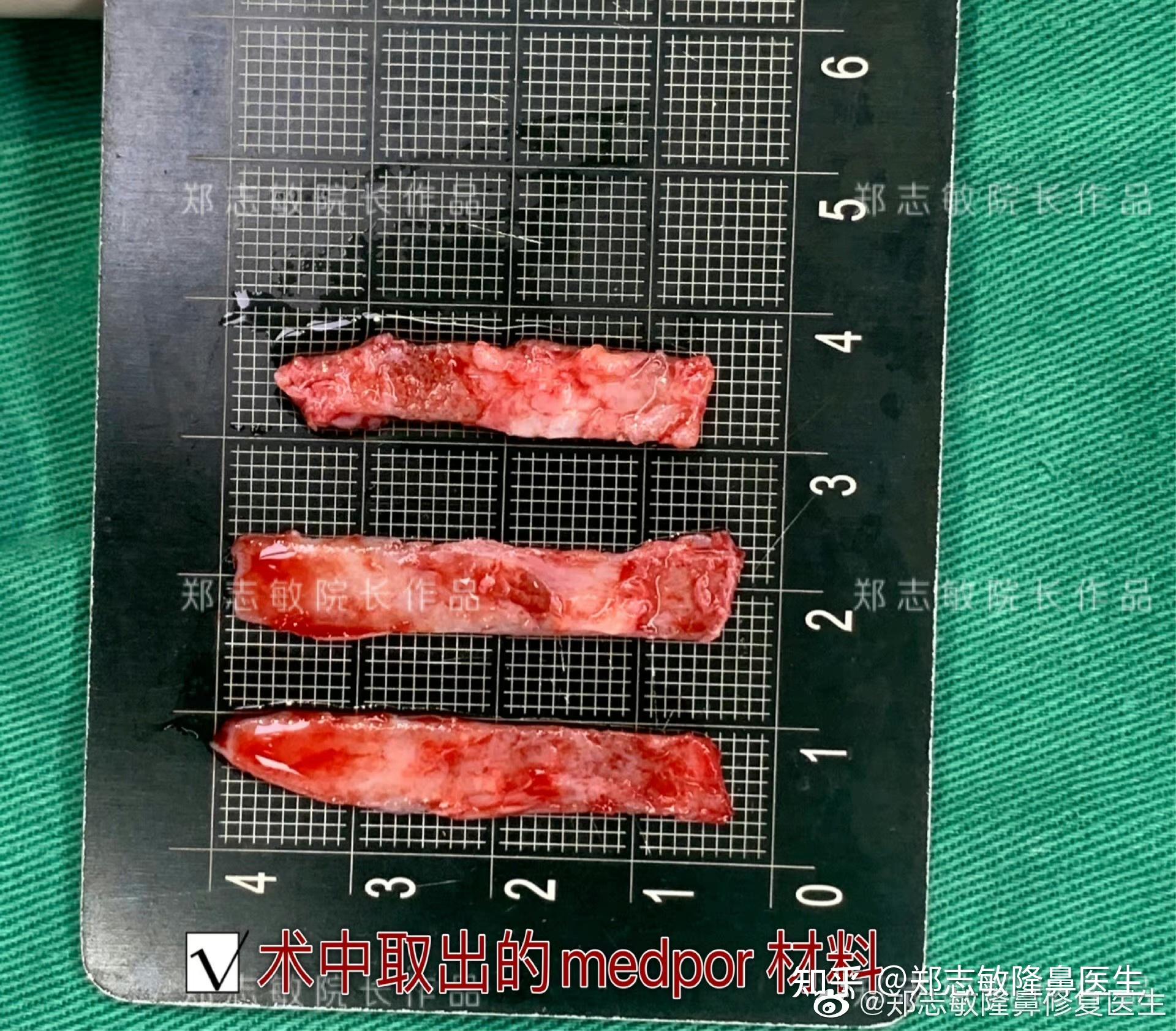 超肋是什么材料可以替代自体软骨肋软骨耳软骨来做鼻子吗