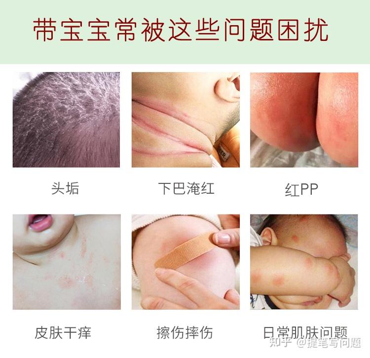 宝宝脸上湿疹可以直接涂山茶油