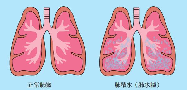 肺積水在飲食上有什麼忌口嗎 李中偉?